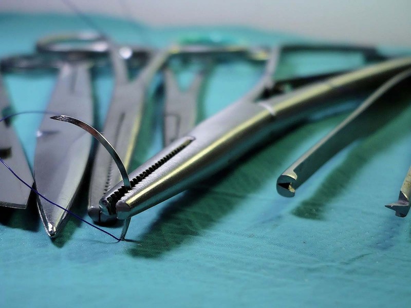 Mujer vivió 20 años con tijeras en su abdomen; médicos las olvidaron tras cirugía